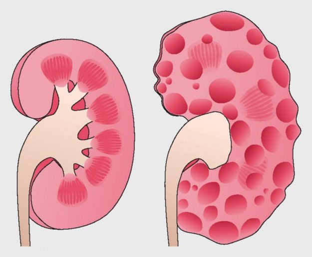 Kidney-Diseases