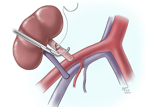 Kidney Transplantation (گردے کا ٹرانسپلانٹیشن)