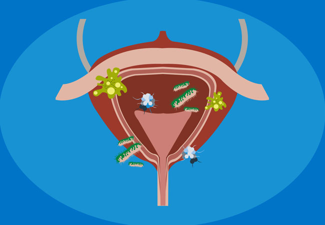 Urinary Tract Infection (مثانے کی انفکشن)