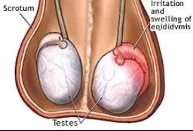 Infection of testis /Epididymo-orchitis (خصیےکی انفکشن)