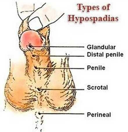hypospadias_1