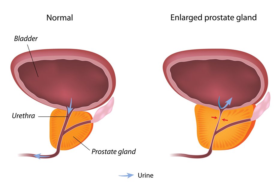 Enlargement of Prostate (پراسٹیٹ غدود)