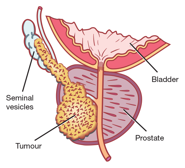 prostate_cancer