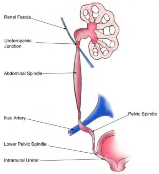 ureter obstruction