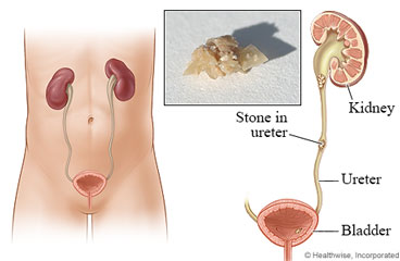 ureter stone